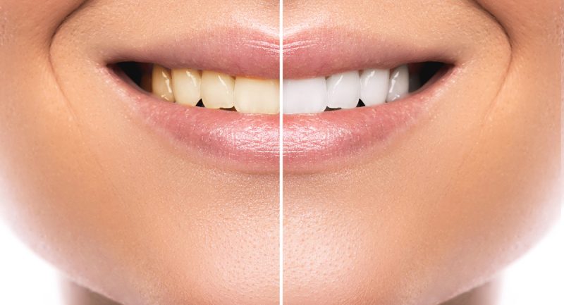 Comparison after teeth whitening